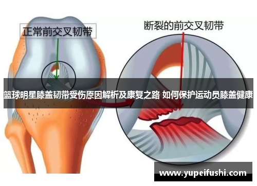 篮球明星膝盖韧带受伤原因解析及康复之路 如何保护运动员膝盖健康